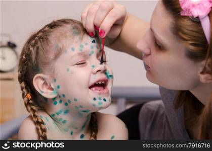 MomMom misses zelenkoj sores on the face of a child suffering from chickenpox misses zelenkoj sores in a child with chickenpox. Mom misses zelenkoj sores in a child with chickenpox