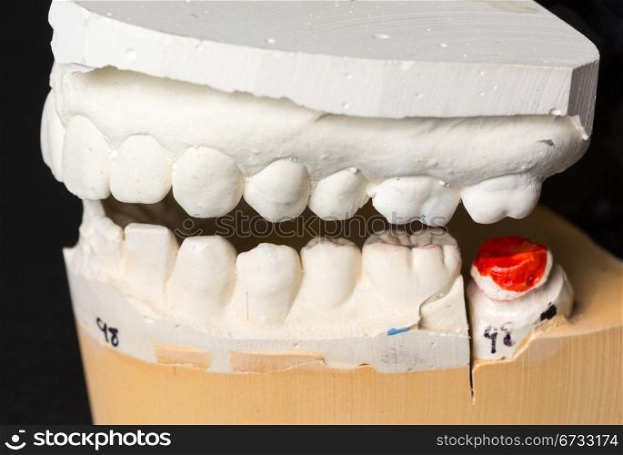 Mould of teeth in plaster taken to prepare brace for orthodontics
