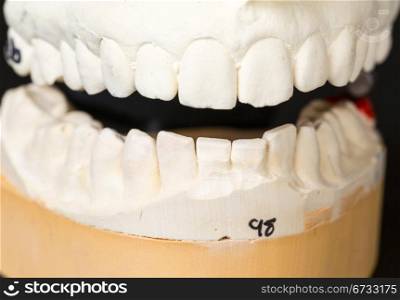 Mould of teeth in plaster taken to prepare brace for orthodontics