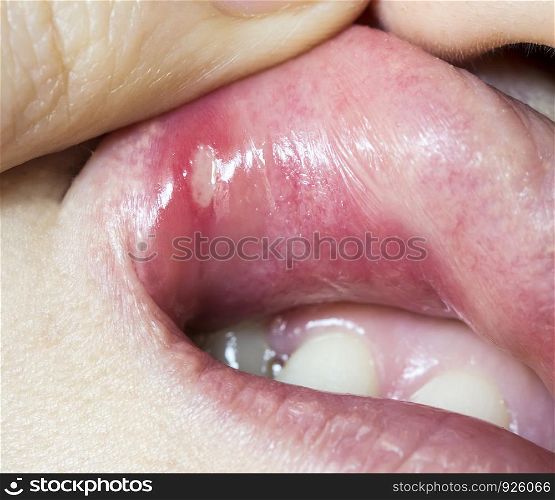 Mouth ulce