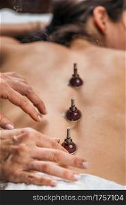 Moxibustion Traditional Chinese Medicine Treatment. Hands of a practitioner placing a mugwort moxibustion therapy burning sticks on woman&rsquo;s back. Moxibustion Traditional Chinese Medicine Treatment
