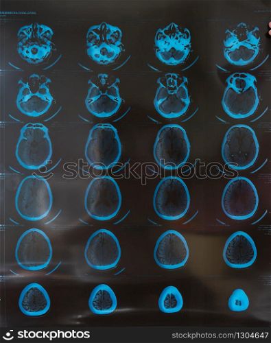 MRI or magnetic resonance image of head and brain scan. Close up view, toned image