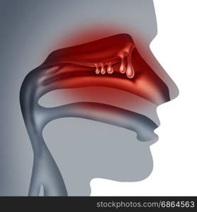 Nasal polyps medical concept as noncancerous swelling and growth as a human sinuses congestion symptom symbol in a 3D illustration style.