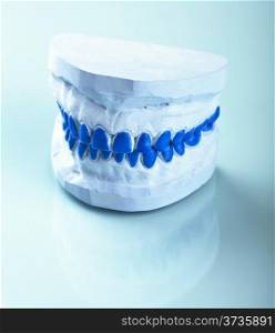 ndividual plaster dental molds to make trays