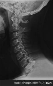 Neck and nape x-ray scan of a 42 year old adult male. Cervical vertebrae human anatomy.