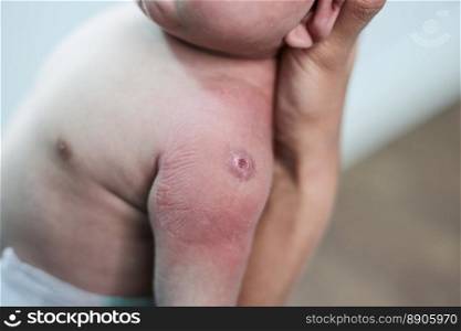 Newborn baby with red spots due to injection