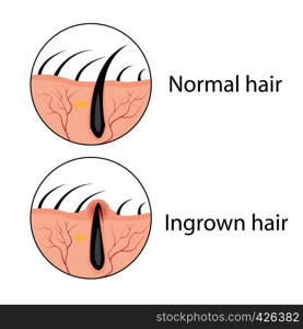 Normal and ingrown hair vector illustration. Skincare problem.