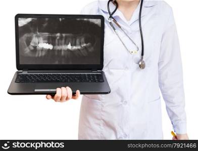 nurse holds computer laptop with X-ray picture of human teeth on screen isolated on white background