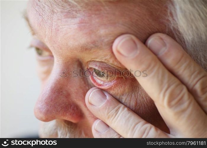 Older man has fatigue and eyestrain.