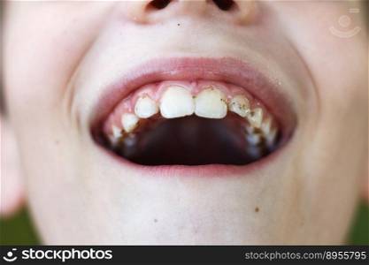 open mouth of a child boy with plaque or calculus on the teeth close. oral hygiene concept.. open mouth of a child boy with plaque or calculus on the teeth close. oral hygiene concept