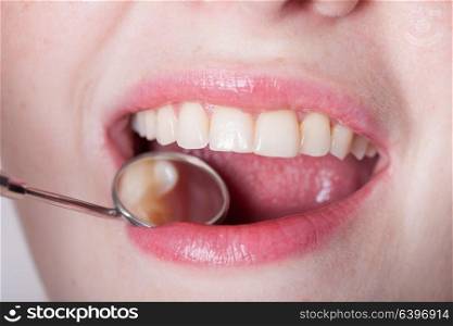 Open mouth of woman with dentist mirror during checking teeth. Check the teeth