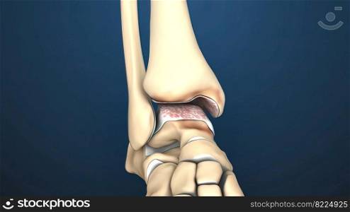 Osteoarthritis is the most common form of arthritis 3d illustration. Osteoarthritis is the most common form of arthritis