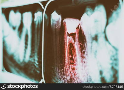 Pain Of Tooth Decay On Teeth X-Ray