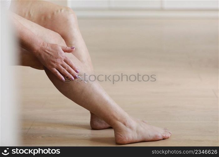 Painful varicose and spider veins on active womans legs, self-helping herself in overcoming the pain. Vascular disease, varicose veins problems, active life concept. Painful varicose and spider veins on active womans legs, self-helping herself in overcoming the pain. Vascular disease, varicose veins problems, active life concept.