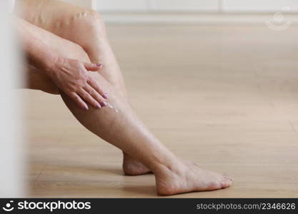 Painful varicose and spider veins on active womans legs, self-helping herself in overcoming the pain. Vascular disease, varicose veins problems, active life concept. Painful varicose and spider veins on active womans legs, self-helping herself in overcoming the pain. Vascular disease, varicose veins problems, active life concept.