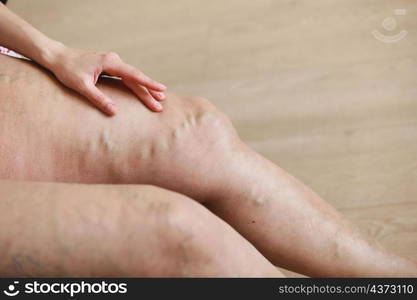 Painful varicose and spider veins on active womans legs, self-helping herself in overcoming the pain. Vascular disease, varicose veins problems, active life concept. Painful varicose and spider veins on active womans legs, self-helping herself in overcoming the pain. Vascular disease, varicose veins problems, active life concept.