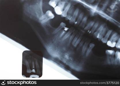 Panoramic and detail x-ray image scan of humans teeth