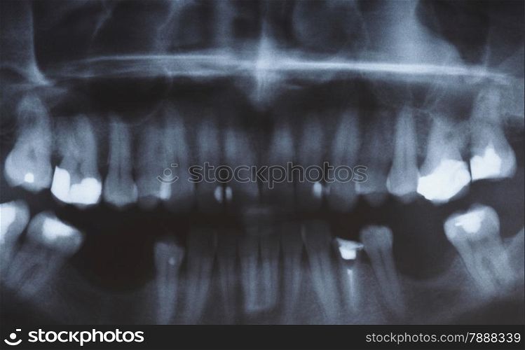 Panoramic x-ray image scan of humans teeth