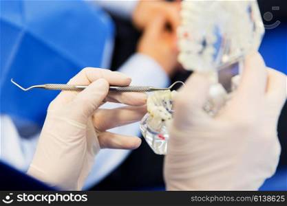 people, medicine, stomatology and health care concept - close up of dentist hands with jaw or teeth layout and dental probe at dental clinic office