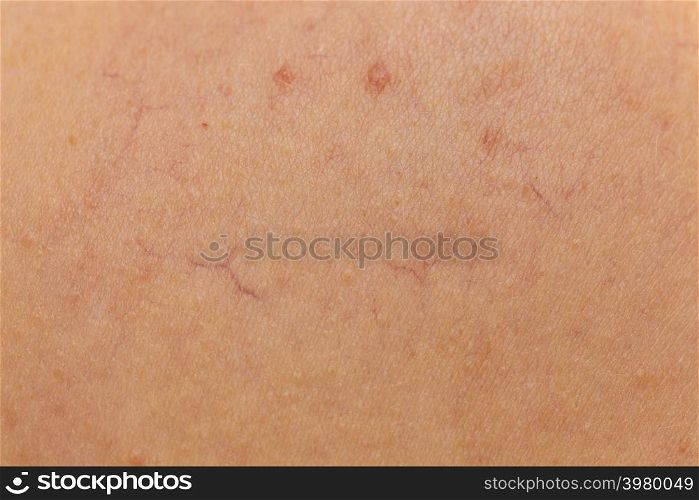 Person having dermatoses on her skin. Skincare problems concept. Close up of dilated capillaries, spider veins, red bumps.. Ski with dilated capillaries ad red spots