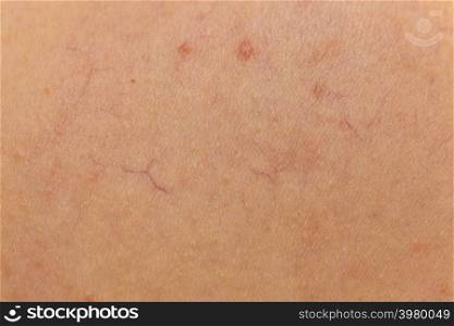 Person having dermatoses on her skin. Skincare problems concept. Close up of dilated capillaries, spider veins, red bumps.. Ski with dilated capillaries ad red spots