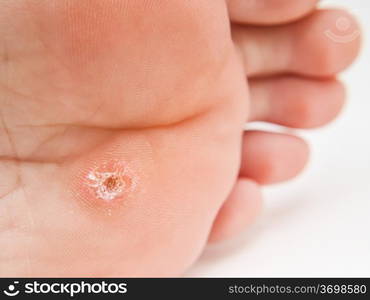 Person with callus located under foot, close to toes towards white