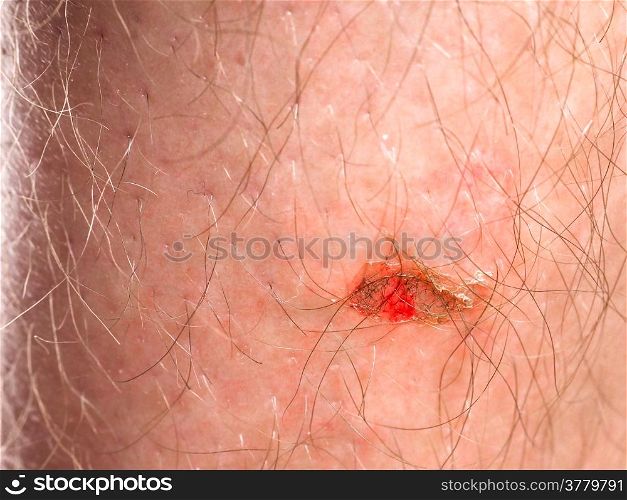 Person with injury on skin under hair