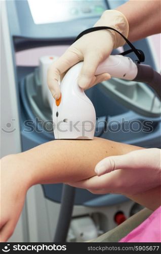 photo epilation. Laser epilation or photo epilation of woman hand