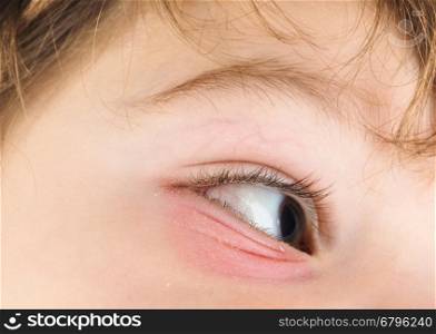 Pink eye on a boy child, at closeup with brown eye and brunette hair