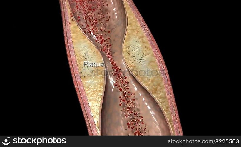 Plaque clogged artery. Digital 3D illustration. Plaque clogged artery. Digital illustration.