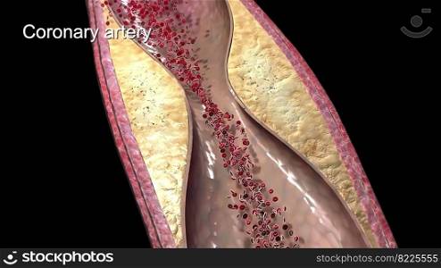 Plaque formation in the cardiovascular system 3D illustration. Plaque formation in the cardiovascular system