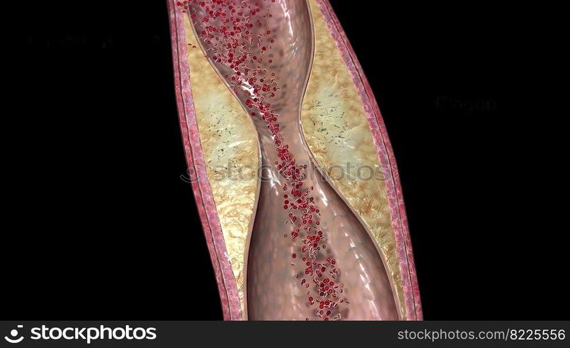 Plaque formation in the cardiovascular system 3D illustration. Plaque formation in the cardiovascular system