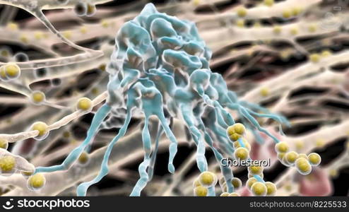 Plaque formation in the cardiovascular tract 3D illustration. Plaque formation in the cardiovascular tract