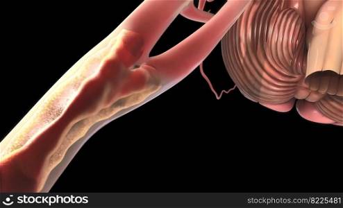 Plaque that forms inside the carotid arteries 3D illustration. Plaque that forms inside the carotid arteries