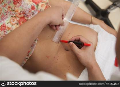 Plotting Points for Acupuncture Treatment