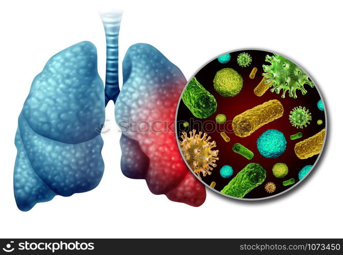 Pneumonia infection anatomy as a medical concept as inflammation in the human lungs infected by virus and bacteria as a lung disease diagnosis with 3D illustration elements.