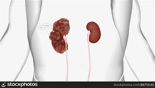 Polycystic kidney disease (PKD) is an inherited disorder of the kidneys. 3D rendering. Polycystic kidney disease (PKD) is an inherited disorder of the kidneys.