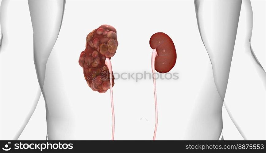 Polycystic kidney disease  PKD  is an inherited disorder of the kidneys. 3D rendering. Polycystic kidney disease  PKD  is an inherited disorder of the kidneys.