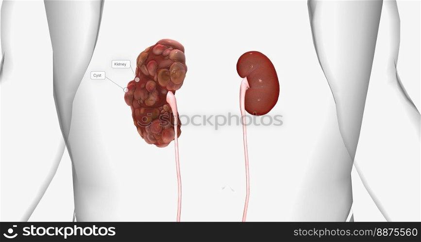 Polycystic kidney disease  PKD  is an inherited disorder of the kidneys. 3D rendering. Polycystic kidney disease  PKD  is an inherited disorder of the kidneys.