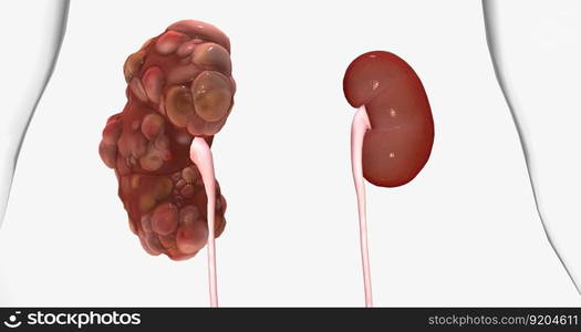 Polycystic kidney disease (PKD) is an inherited disorder of the kidneys. 3D rendering. Polycystic kidney disease (PKD) is an inherited disorder of the kidneys.