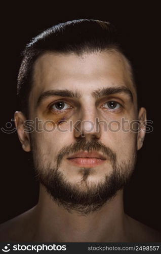 Portrait of a man with bruised skin and black eye. Violence fight eye hematoma shiner.
