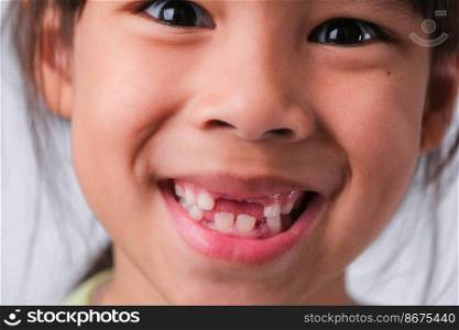 Portrait of an Asian girl with broken upper baby teeth and first permanent teeth. Friendly little girl showing her broken teeth isolated on white background.