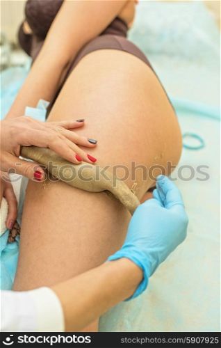 procedure. procedure for women hip for cellulite and fat