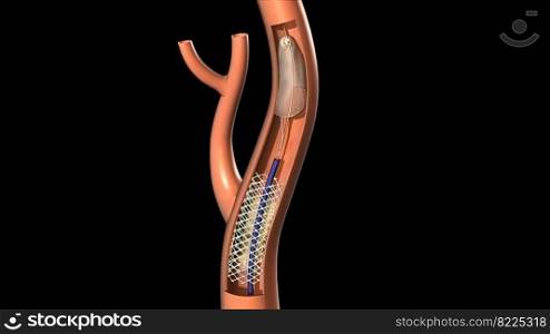 Protected Carotid Stenting 3d medical illustration. Protected Carotid Stenting