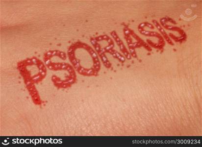 Psoriasis autoimmune disease as dry red skin patches as a symbol for dermatology illness in a 3D illustration style.