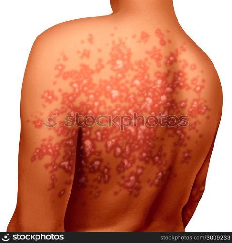 Psoriasis illness and autoimmune disease as dry red skin patches on a patient as a symbol for dermatology illness in a 3D illustration style.