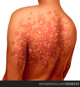 Psoriasis illness and autoimmune disease as dry red skin patches on a patient as a symbol for dermatology illness in a 3D illustration style.