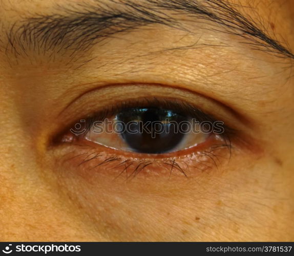 Pterygium in the eye