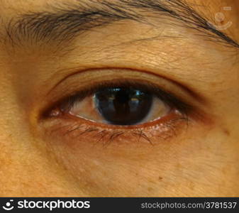 Pterygium in the eye