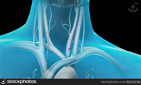 pulmonary embolism blood clotting 3D illustration. pulmonary embolism-blood clotting